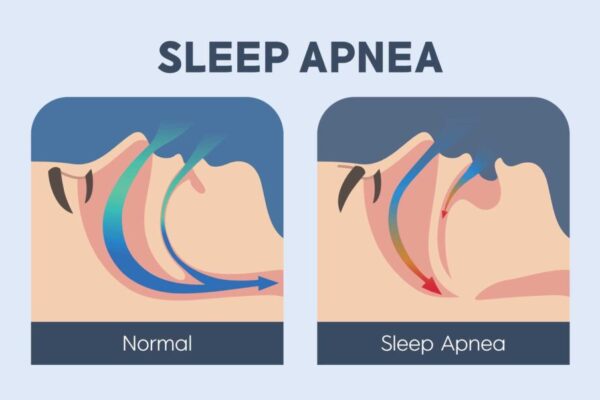 APNEEA IN SOMN