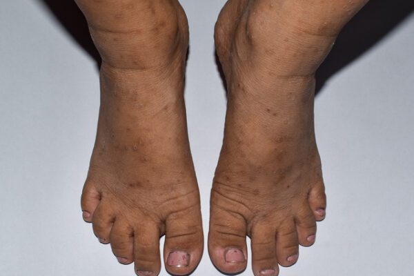 Cele 10 porunci ale piciorului diabetic