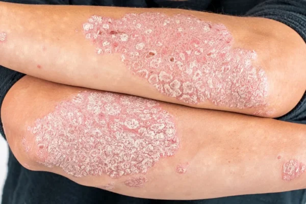 Regim alimentar psoriazis vulgar
